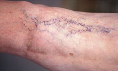 методи за лечение на разширени вени на краката