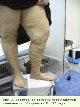 Разширените вени трябва да се лекуват, за да се спре процесът