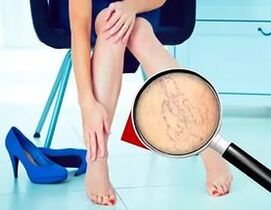 Симптомите зависят от естеството и стадия на разширените вени