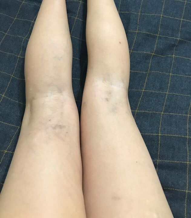 прояви на разширени вени по краката